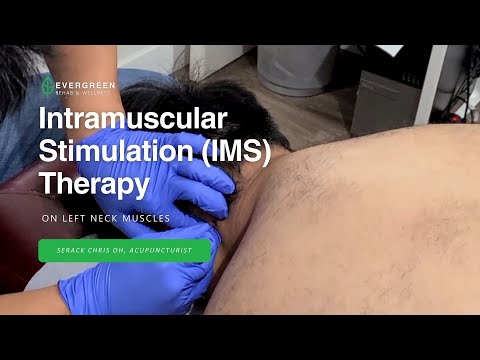 Intramuscular Stimulation (IMS) Therapy on Left Neck Muscles