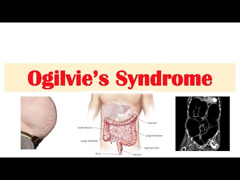 Irritable Bowel Syndrome IBS Causes Symptoms Bristol Stool Chart Types and Treatment