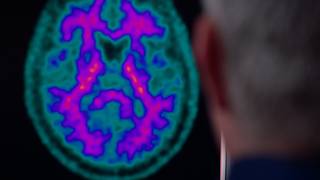 Dr. Rosa Rademakers explains ALS-dementia gene research and discovery