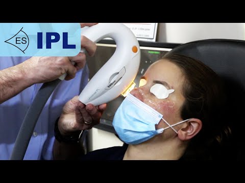 IPL Treatment for Dry Eye (Intense Pulsed Light Therapy)