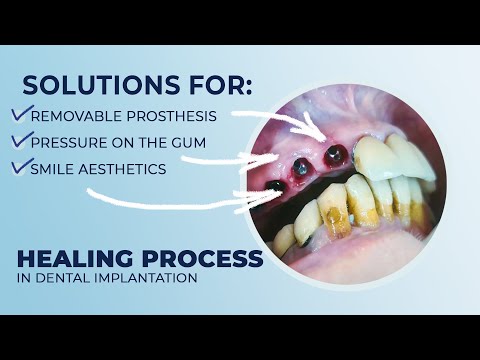 How to avoid the use of a removable denture and reduce the load in the healing process on multi unit