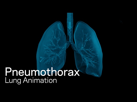Pneumothorax
