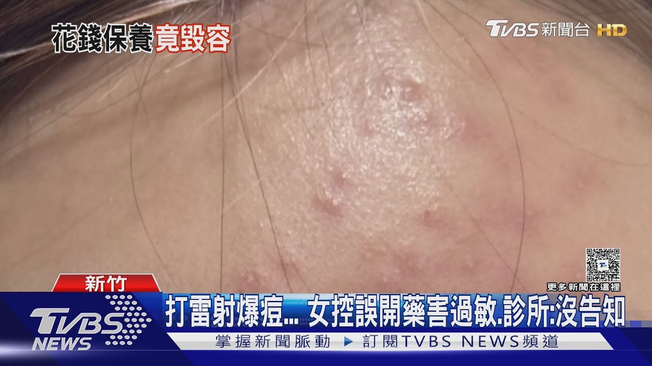 打雷射爆痘...女控誤開藥害過敏 診所:沒告知