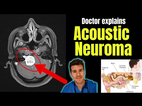 Doctor explains Acoustic Neuroma - including symptoms, investigations and treatment!
