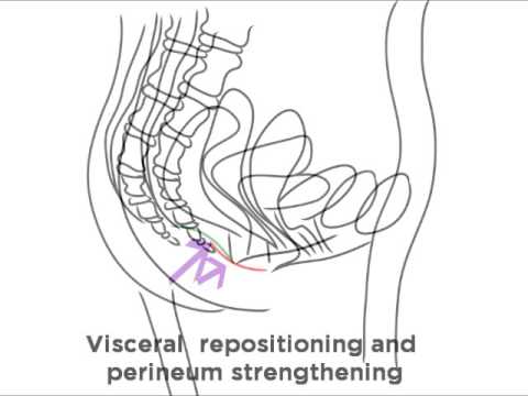 Urinary Incontinence Improvement- Hypopressives LPF