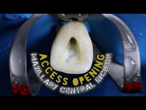 Access Opening of Maxillary Central Incisor | step by step demonstration