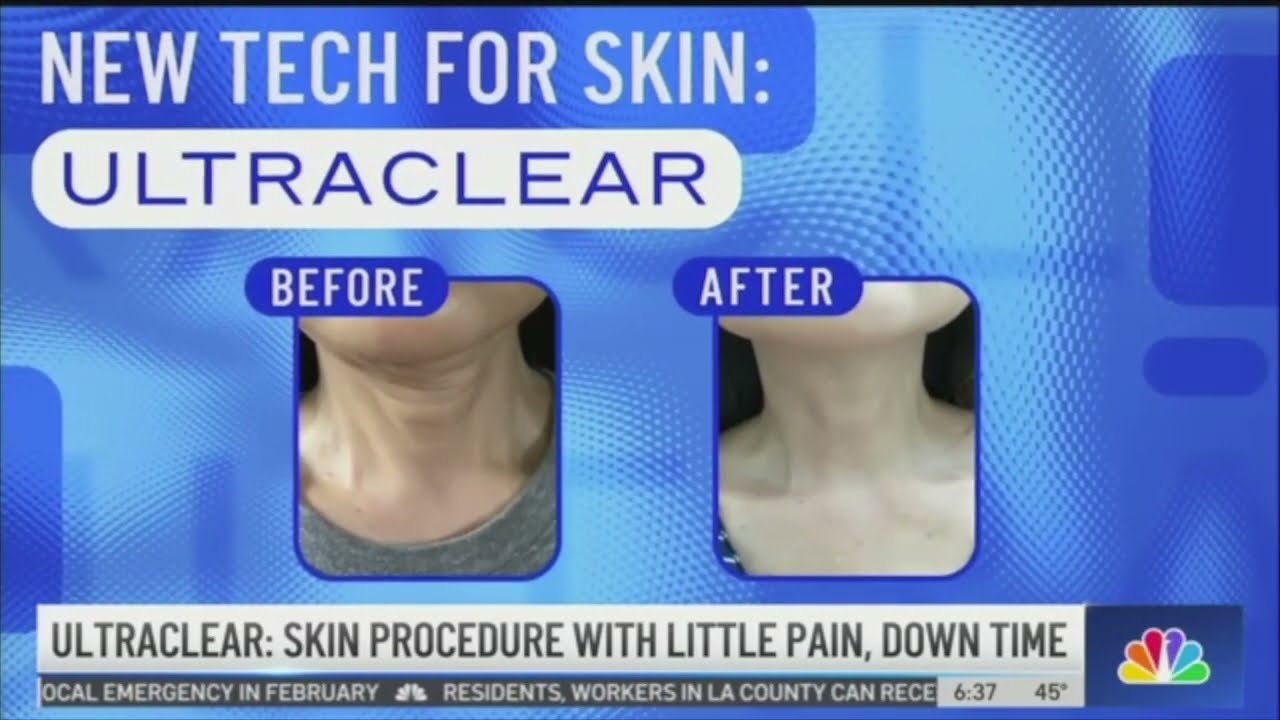 Dr. Glynis Ablon Talks UltraClear on NBC TV