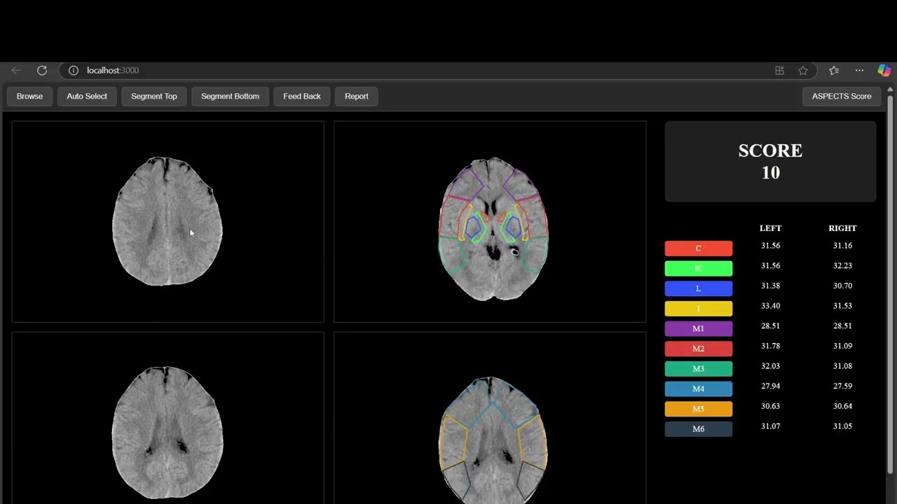 AI Stroke ASPECTS Scoring video thumbnail