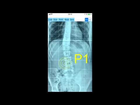 Cobb Angle App
