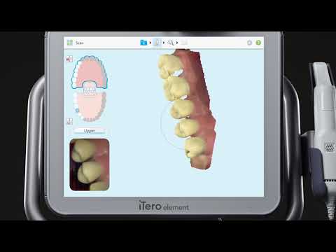 iTero® Scanner Tutorial: Charting and Scanning for an Implant