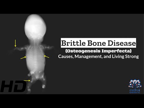 Brittle Bone Breakdown: Demystifying Osteogenesis Imperfecta Causes and Symptoms