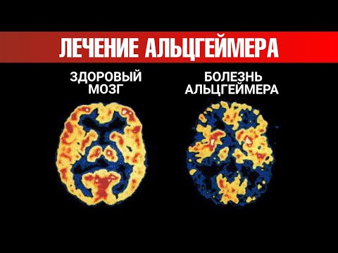 Что провоцирует болезнь Альцгеймера? Революционное открытие🧠