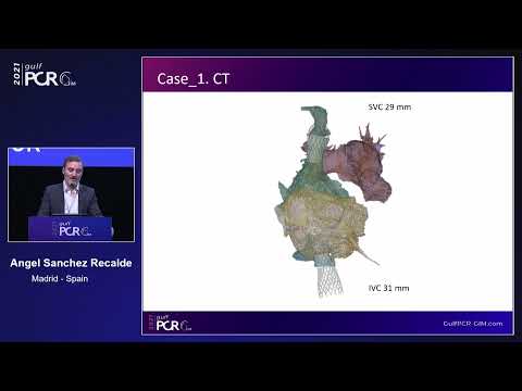 Pushing boundaries in tricuspid therapy: the TricValve solution - GulfPCR-GIM 2021