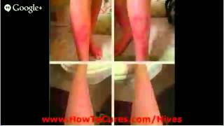 How To Get Rid Of Hives - Cures For Soothing Solar Urticaria - How To Get Rid Of Hives