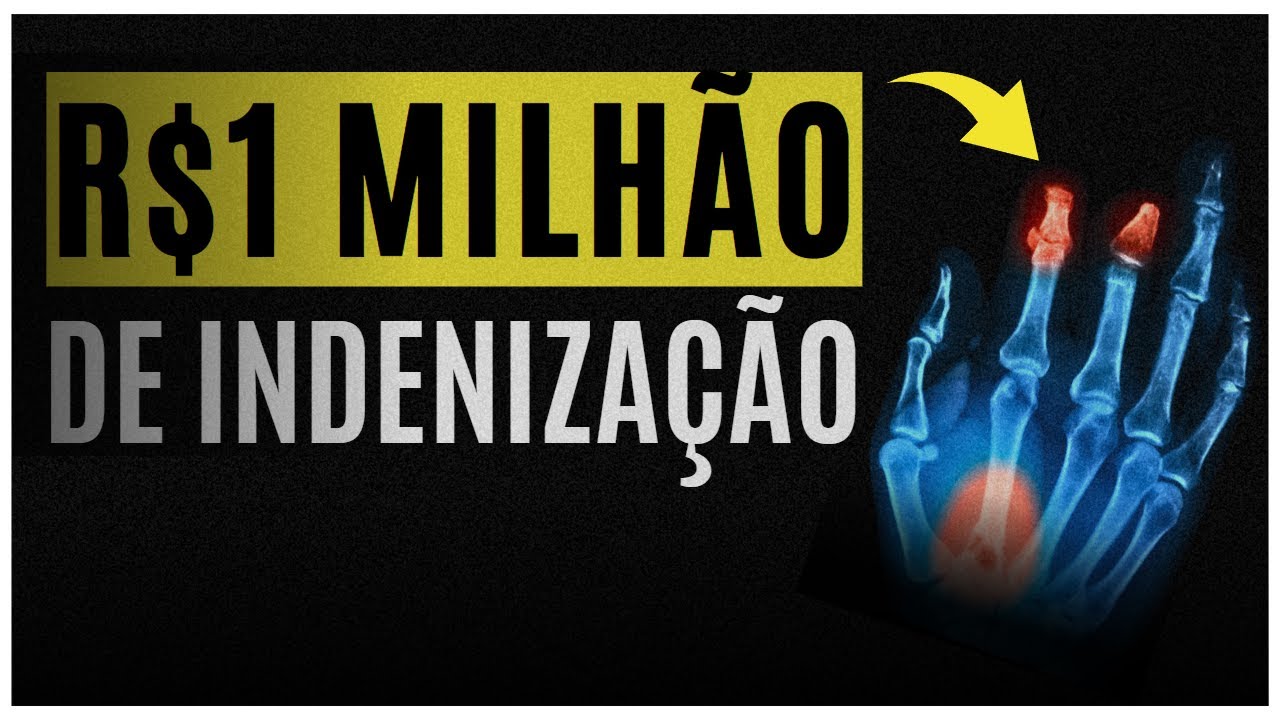 Qual o valor da indenização por perda de dedo? Saiba aqui...