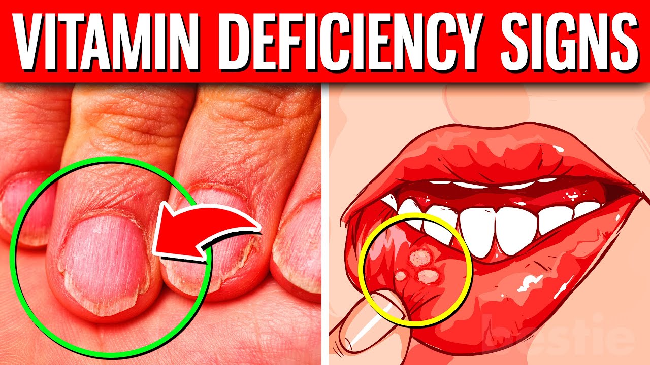 The 10 HIDDEN Signs Of Vitamin Deficiency You Should Never Ignore!