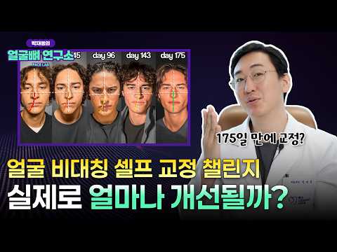 안면비대칭 셀프 교정, 175일 만에 가능? 팩트 체크해봤습니다