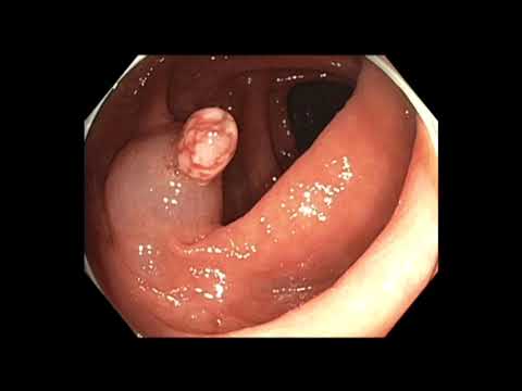 La coloscopie: mucosectomie endoscopique (EMR) d'un polype inflammatoire.