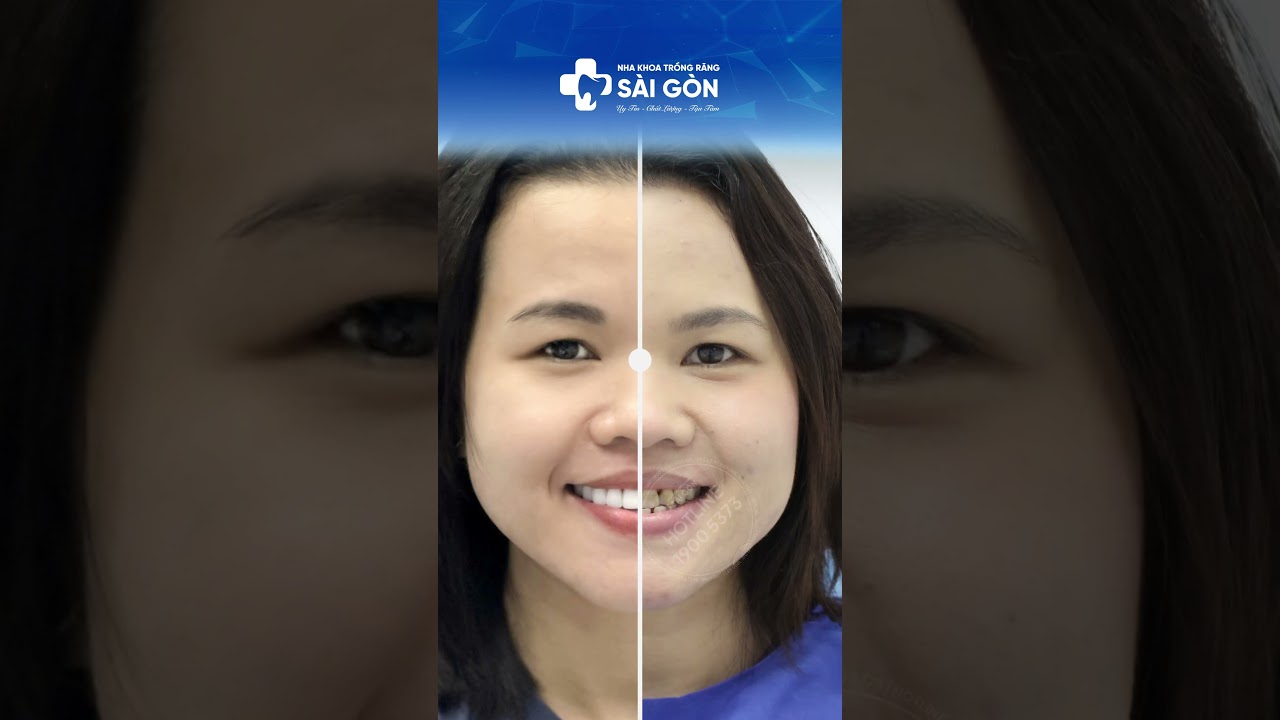 Case Bọc 21 Răng Toàn Sứ Do Nhiễm Tetra | Nha Khoa Trồng Răng Sài Gòn #bocrangsu #rangsuthammy