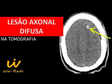 Lesão Axonal Difusa (LAD) na Tomografia Computadorizada (TC) de  Crânio