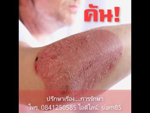 ชื่อโรคสะเก็ดเงินเป็นหนอง ฉีดที่ให้โรคสะเก็ดเงิน