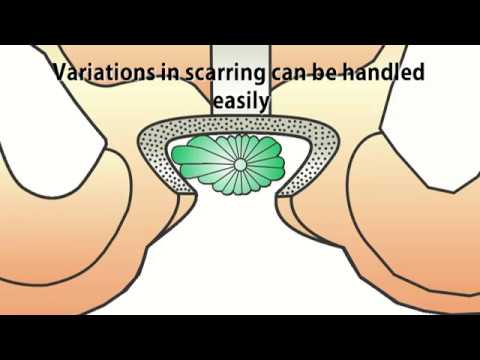 Omega Pubectomy To Improve The Exposure During PFUDD Repair • Video • MEDtube.net