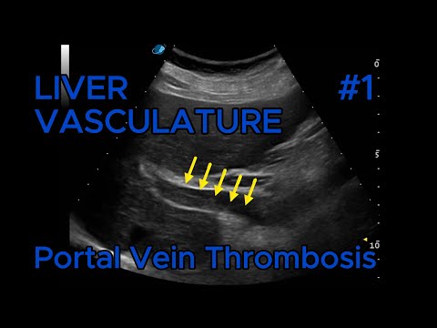 Portal vein thrombosis video preview