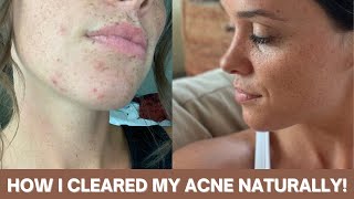 HOW I CLEARED MY ACNE NATURALLY | Long Term Results