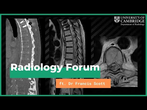 'Thoracolumbar Spine Trauma - Three Columns and Beyond' by Dr Francis Scott
