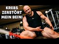 Der Krebs hat mein Bein zerstört!