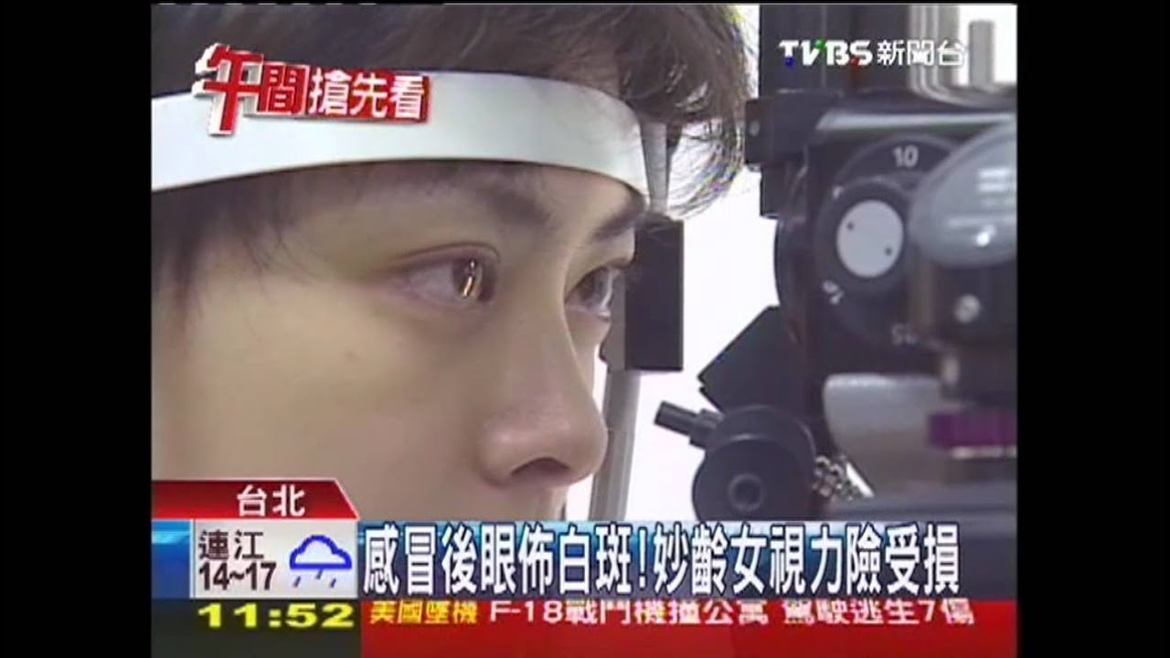 感冒後眼佈白斑！妙齡女視力險受損