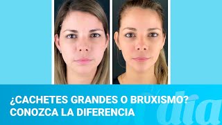 ¿Cachetes grandes o bruxismo Conozca la diferencia