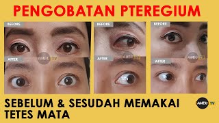 Download lagu PTEREGIUM PINGUECULA EYE TREATMENT WITHOUT SURGERY - EYE DROPS - EPISODE 2 THE END mp3
