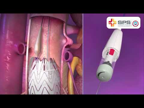 EVAR or Endovascular Aneurysm Repair Procedure | SPS Hospitals