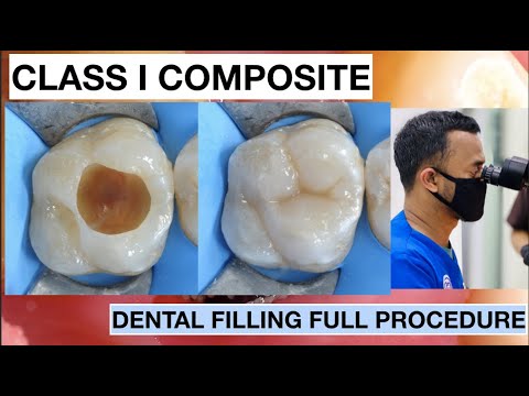Dental Filling Full Procedure Class I Composite