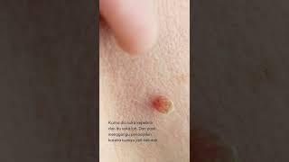 Download lagu SEMAKIN TUA SEMAKIN BANYAK TUMBUH KUTIL (WARTS)?⁣!! mp3