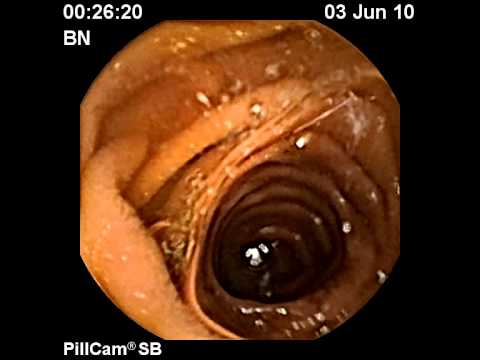 Examen intestinal - cápsula endoscópica