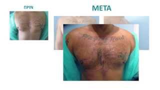 Αποκατάσταση τριχών στήθους με τη μέθοδο Advanced FUE