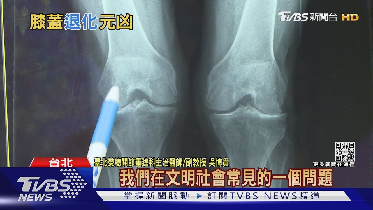 有片/膝蓋退化出現這「關鍵跡象」 醫師:若輕忽後果難想像!