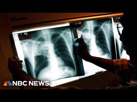 Dozens of tuberculosis cases confirmed in Kansas outbreak