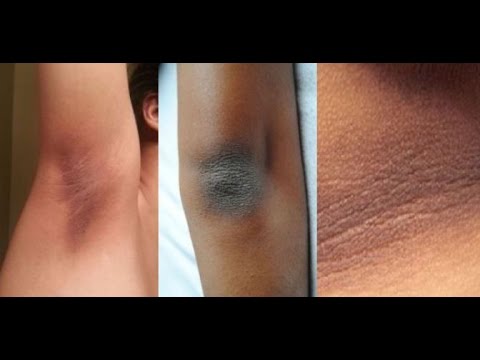 Kung paano mawalan ng timbang sa pamamagitan ng 20 kg para sa 1 araw Video Kung paano kumuha bee pollen para sa pagbaba ng timbang