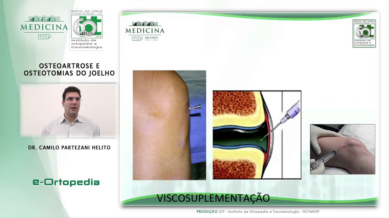 Osteoartrose e Osteotomias do Joelho - Dr. Camilo Partezani Helito