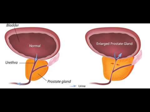 Warum der Saft der Prostata bei Männern passieren Analyse für Tumormarker von Prostata-