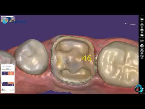 𝗘𝗗𝗔-𝗘𝗶𝗴𝗵𝘁𝗲𝗲𝘁𝗵 𝗗𝗶𝗴𝗶𝘁𝗮𝗹 𝗔𝗰𝗮𝗱𝗲𝗺𝘆-𝑯𝒆𝒍𝒊𝒐𝒔 600: Restoration workflow overview using exocad