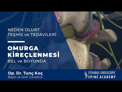 Omurga Kanalı Darlığı ve Tedavi Seçenekleri