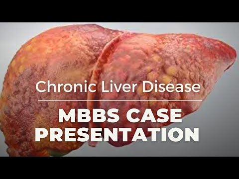 MBBS Case Presentation || CLD