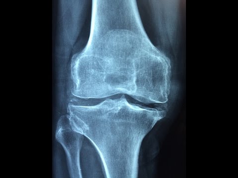 A térdízületi artrózisról - Goodwill Pharma - Webshop