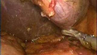 preview picture of video 'colecistectomia  laparoscopica con due trocar . anastasio tricarico-ospedale veneziale isernia'