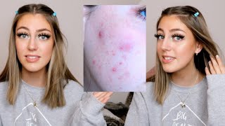 HOW I CLEARED MY SKIN - SELF CARE WEEK