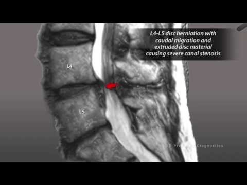 Diagnostic 3D précis: lésions du rachis lombaire en IRM